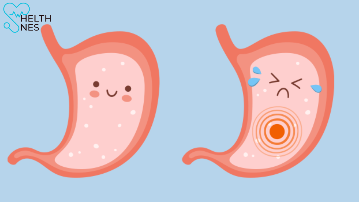 What Is the Fastest Way to Cure a Stomach Ulcer?