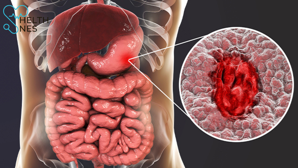 Common Symptoms of Stomach Ulcers