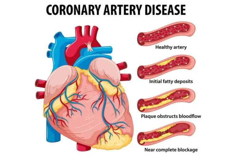 Coronary Artery Disease Symptoms