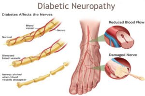 Prevent Diabetes Complications Diabetes Nerve Damage Signs