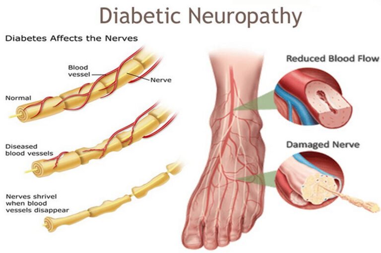 Diabetes Nerve Damage Signs