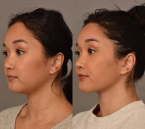 Bee Venom Cream Buccal Fat Removal