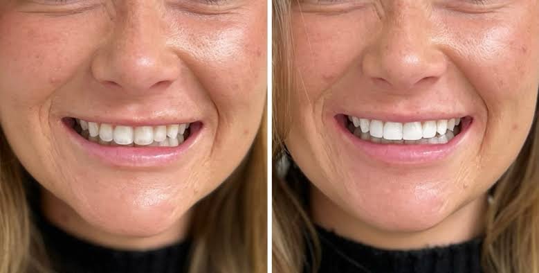 Composite Bonding Teeth Composite Bonding Teeth
