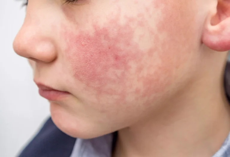 Slapped Cheek Syndrome