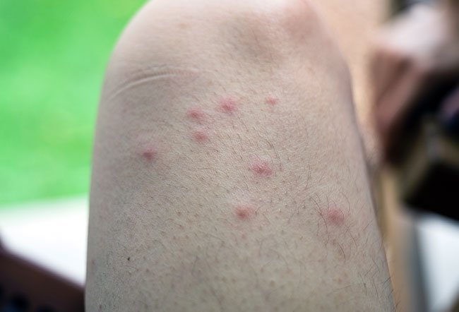 Spider Bite UK