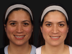 Botox Before and After