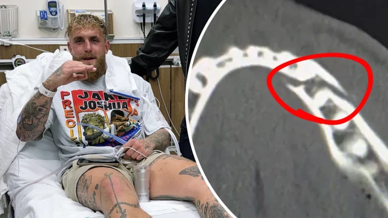 Jake Paul Broken Jaw