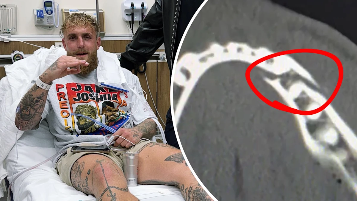 Jake Paul Broken Jaw