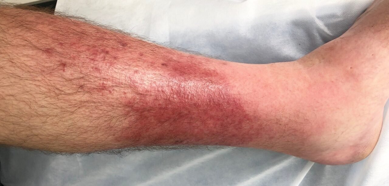 Pictures of Cellulitis