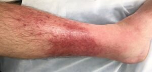 Uv index today Pictures of Cellulitis