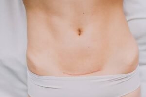 Uv index today C section Scar