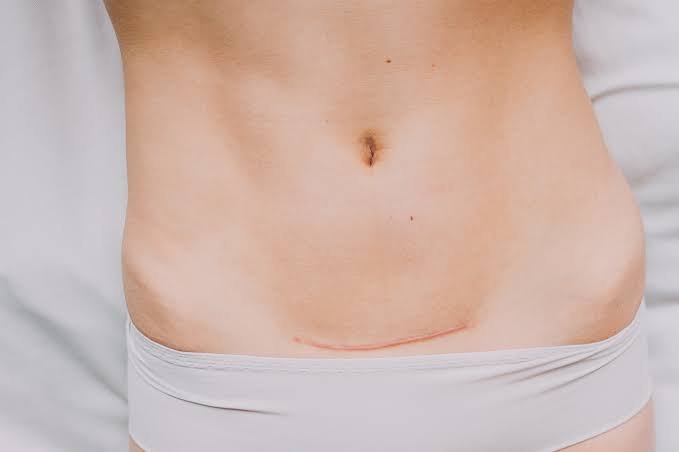 C section Scar