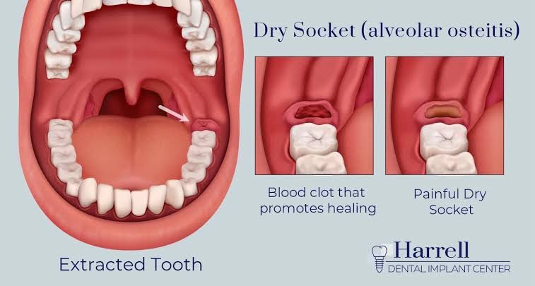 Pictures of Dry Socket vs Normal Healing Pictures of Dry Socket vs Normal Healing